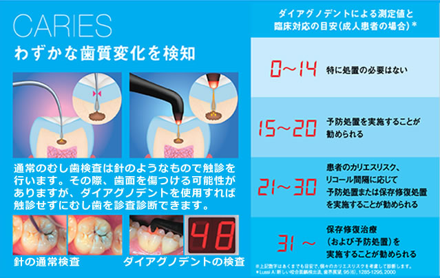 ダイアグノデントの説明