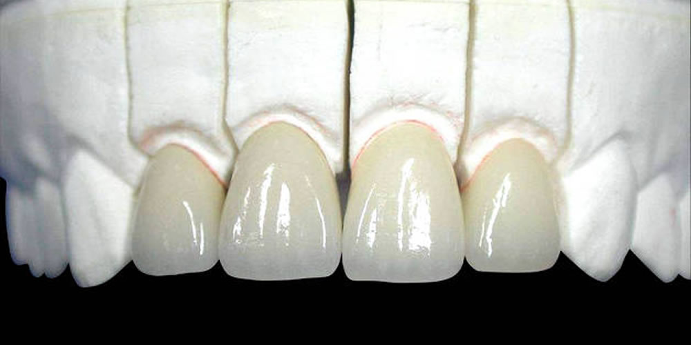 自費のセラミック治療