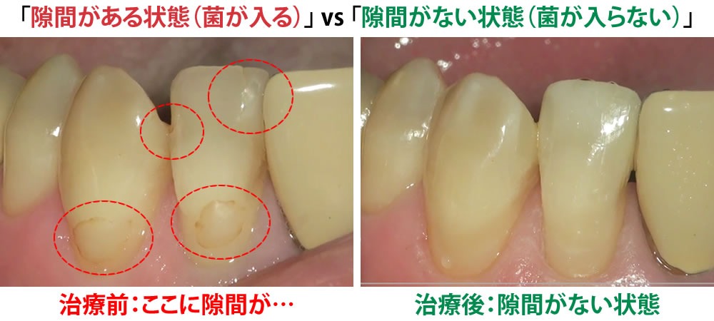 補綴物の適合の重要性