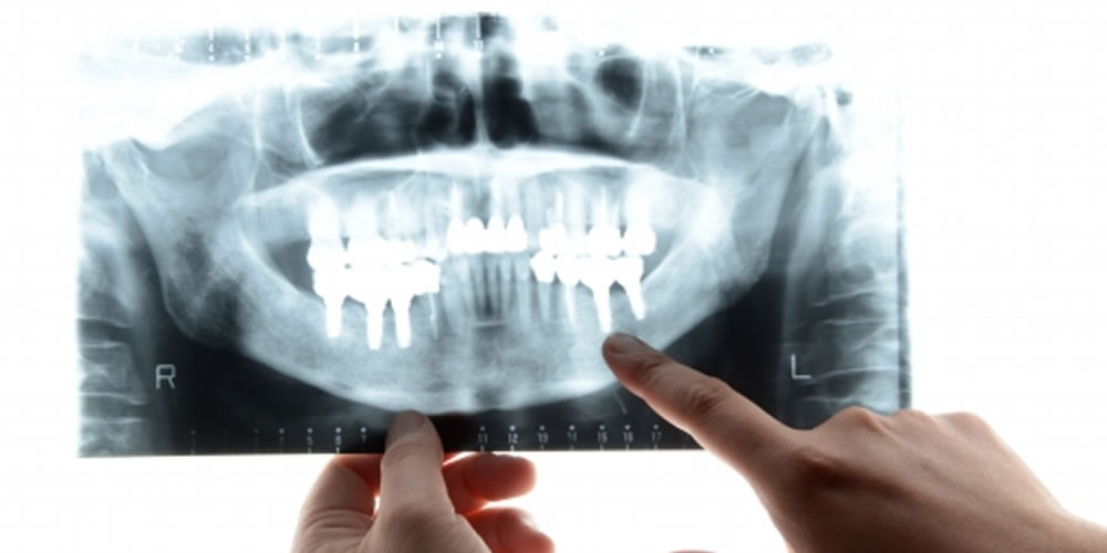 歯科医院で行うレントゲン検査の被ばく線量は大丈夫？