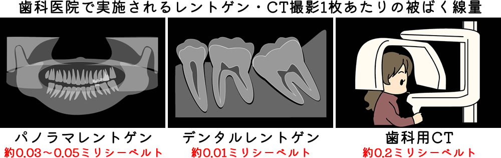 歯科医院で実施されるレントゲン・CT撮影1枚あたりの被ばく線量