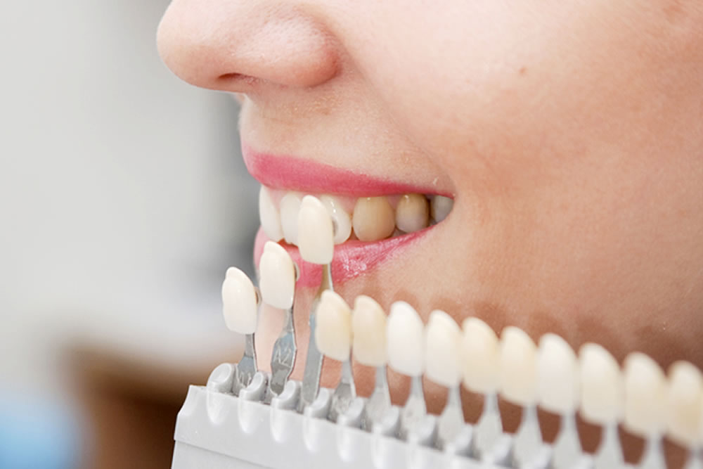 ホワイトニング