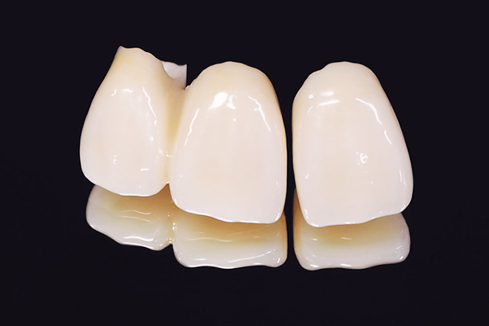 審美治療(セラミックス治療)