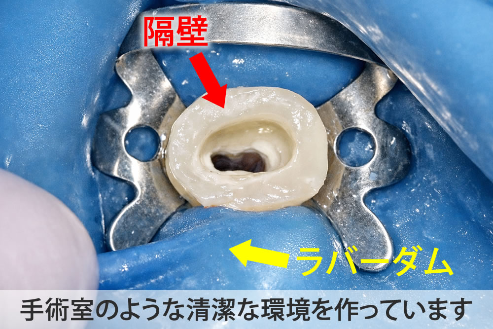 隔壁とラバーダム