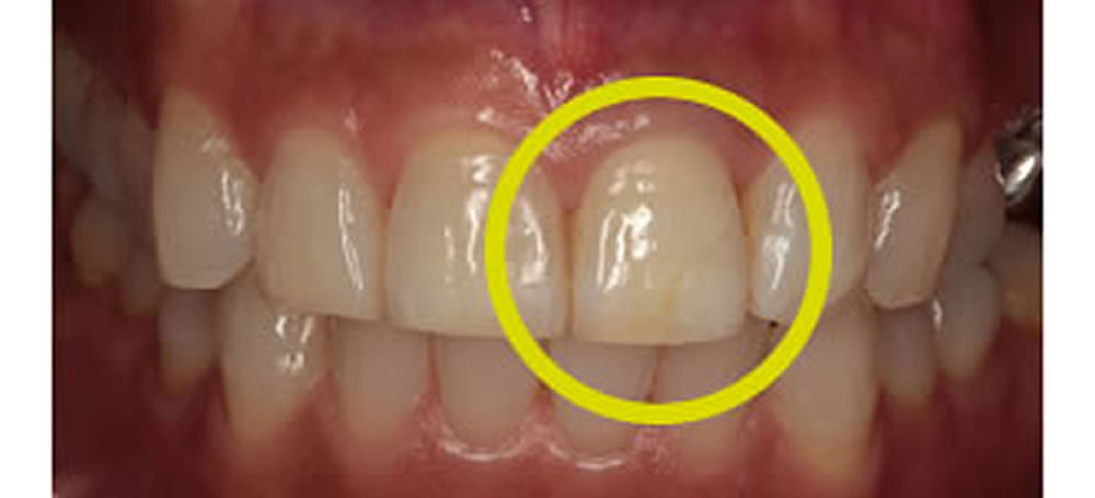 歯を削らずに前歯の根管治療