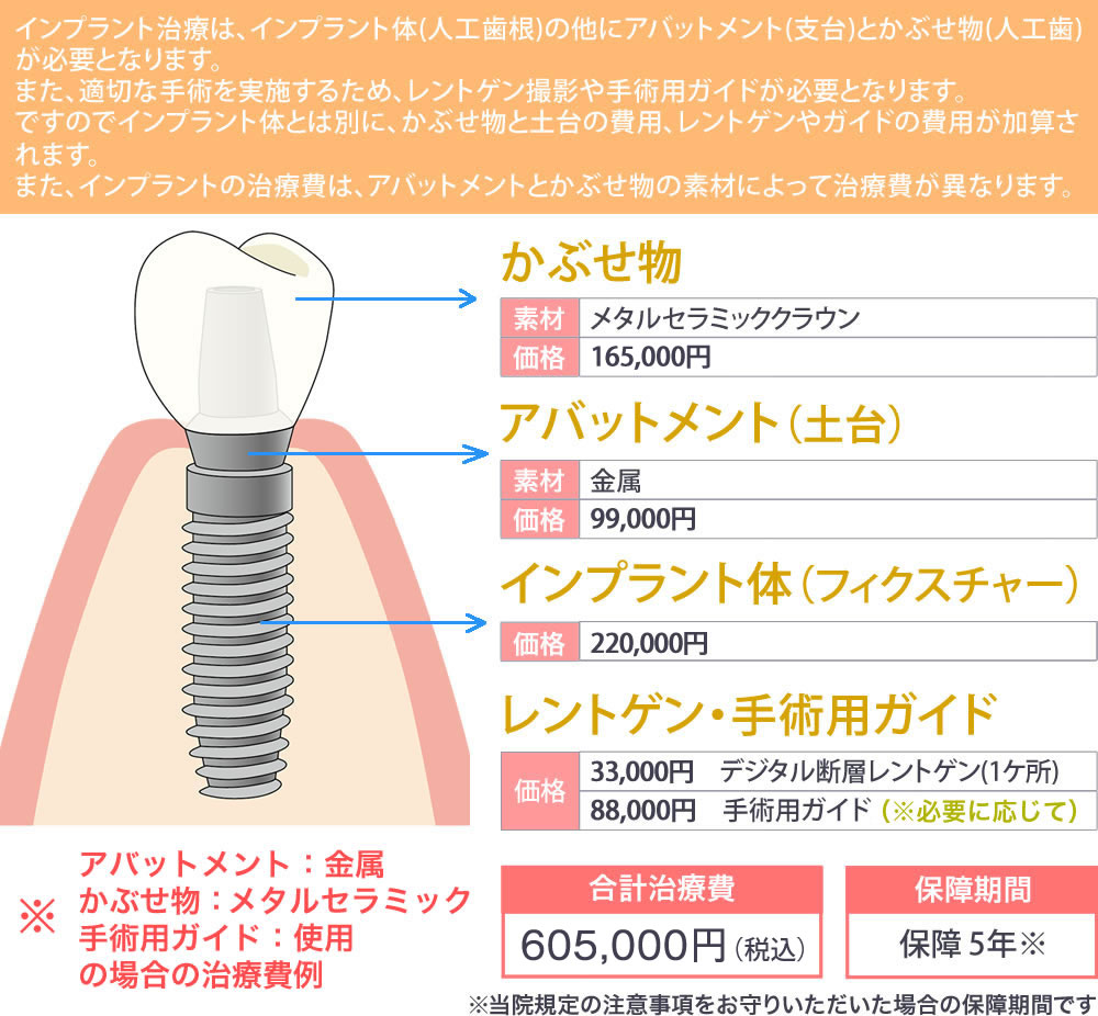 インプラント