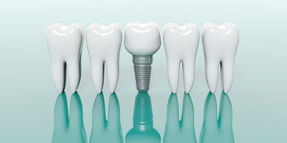 インプラント治療