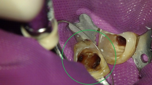 折れたリーマー（ファイル）の除去している根管治療の症例写真1
