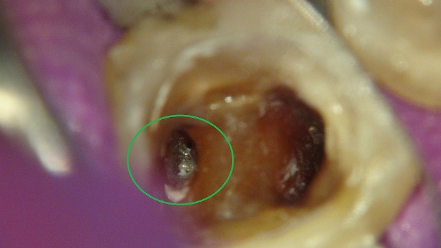 折れたリーマー（ファイル）の除去している根管治療の症例写真2