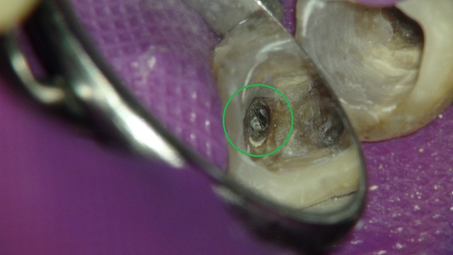 折れたリーマー（ファイル）の除去している根管治療の症例写真4