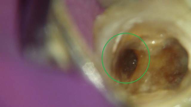折れたリーマー（ファイル）の除去している根管治療の症例写真7