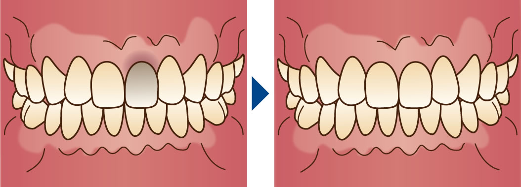 歯の神経が死んで黒ずんだ歯を白くするインターナルブリーチ
