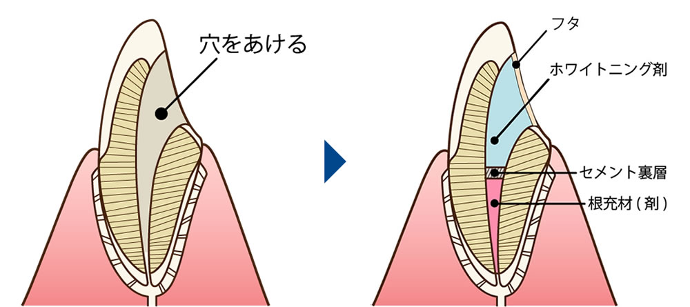 インターナルブリーチ（ウォーキングブリーチ）